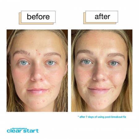 Dermalogica Clear Start Post Breakout Fix - Гель-крем для лікування плям після висипань, 15 мл